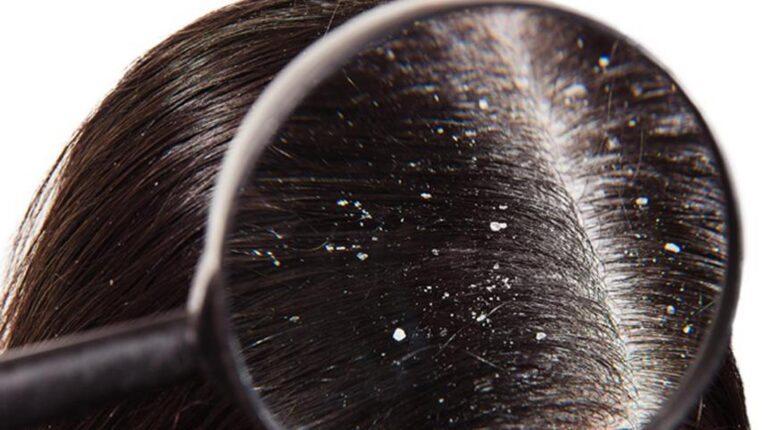 microscope-on-dry-scalp-dandruff